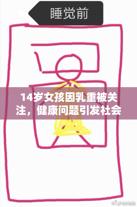 14岁女孩因乳重被关注，健康问题引发社会讨论
